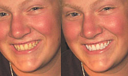  	 Teeth Whitening