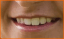 Teeth Whitening In Photoshop CS3