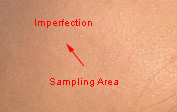 removing skin imperfections