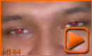 Eliminar Ojos Rojos