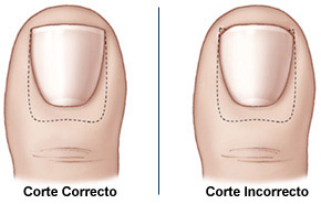 Cómo Prevenir las Uñas Encarnadas (Enterradas)